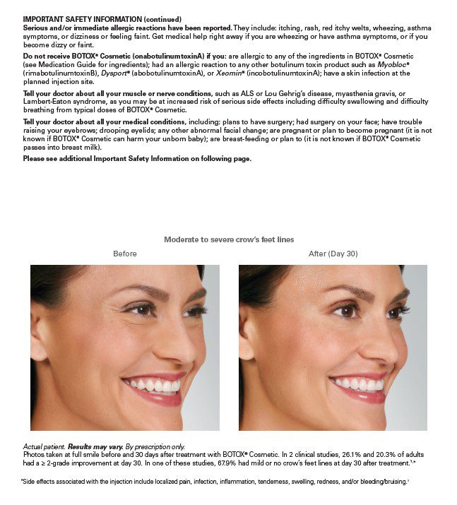 Before and After Botox